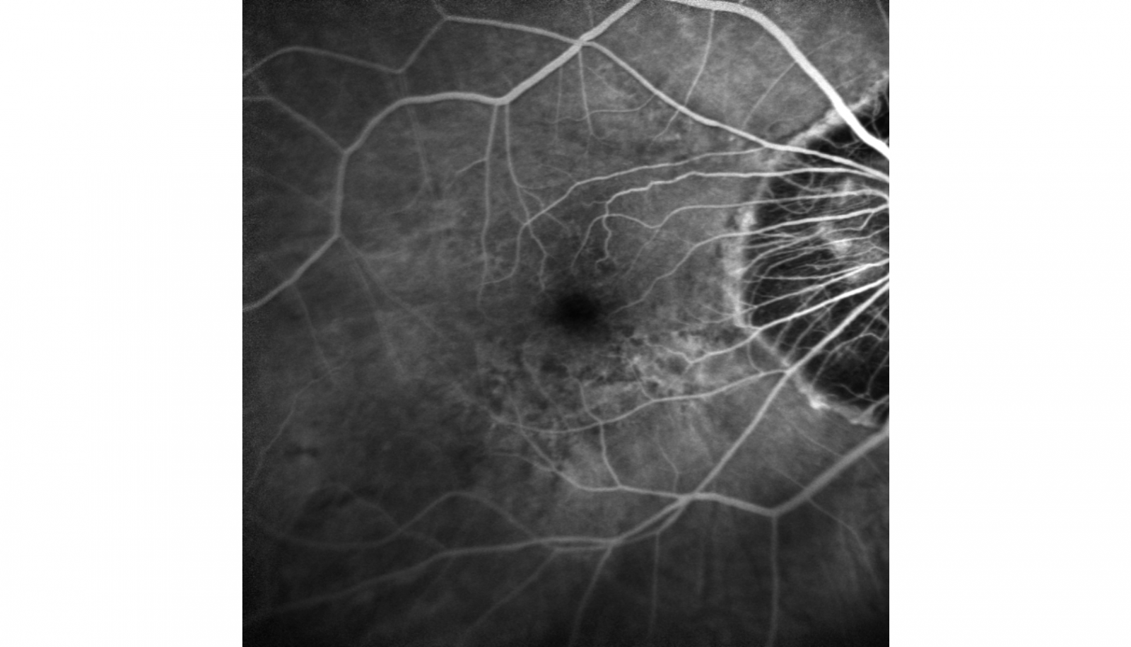 Angiographie - Traitement & Chirurgie des yeux - Savoie